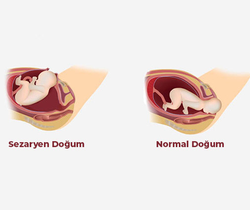 Sezaryen Doğum